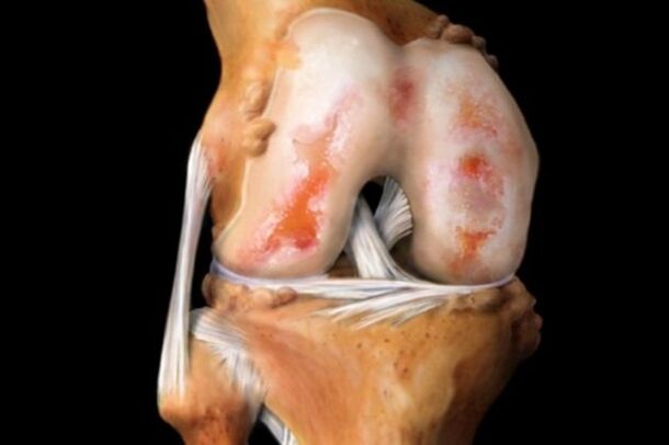 Destruction of the knee joint due to osteoarthritis, a common pathology of the musculoskeletal system