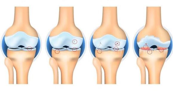 Osteortrosis stages
