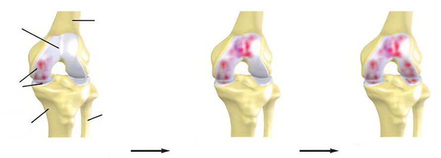 Stages of osteoarthritis