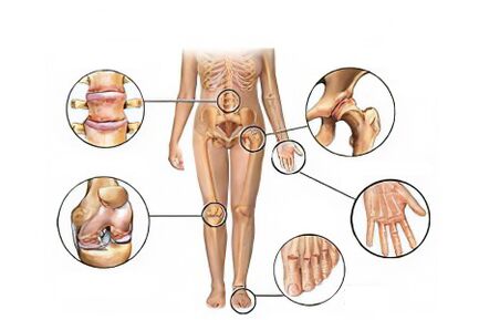 Types of osteoarthritis