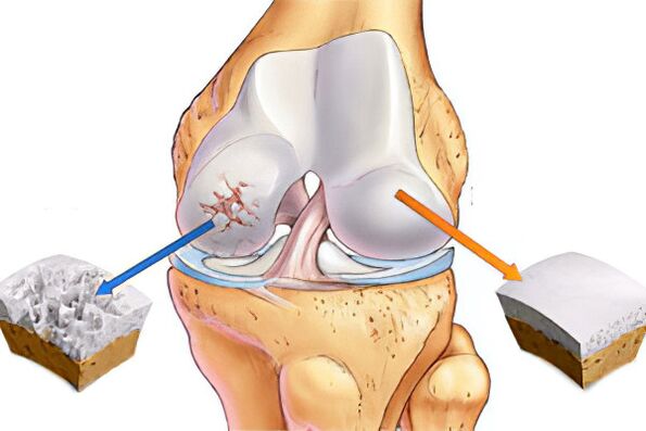 What is osteoarthritis