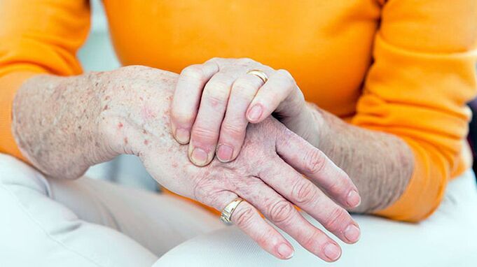 Brush osteoarthritis