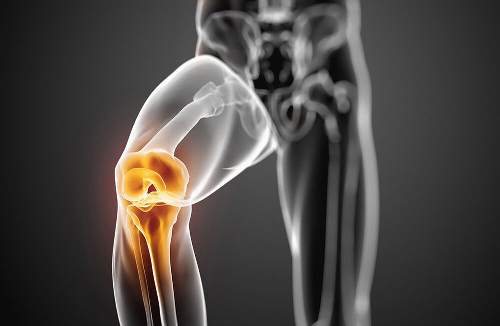 Knee joint osteoarthritis