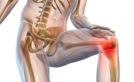 Knee joint osteoarthritis