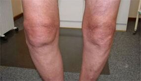 osteoarthritis symptoms