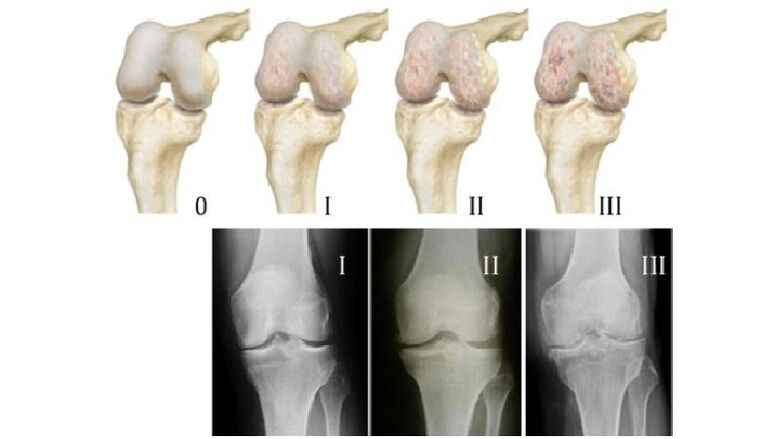Stages of osteoarthritis of the knee joint on x-rays.