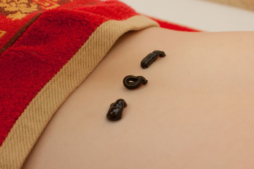 leeches in the lumbar area for osteochondrosis