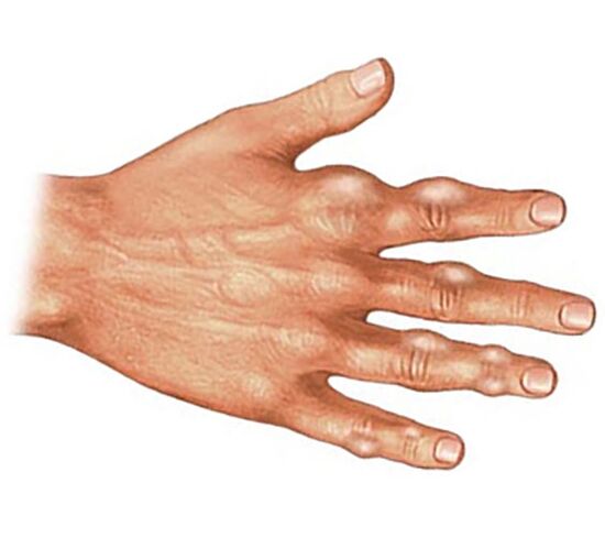 Deposition of uric acid crystals in the soft tissues of the fingers in gouty arthritis.