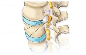 main symptoms of cervical osteochondrosis
