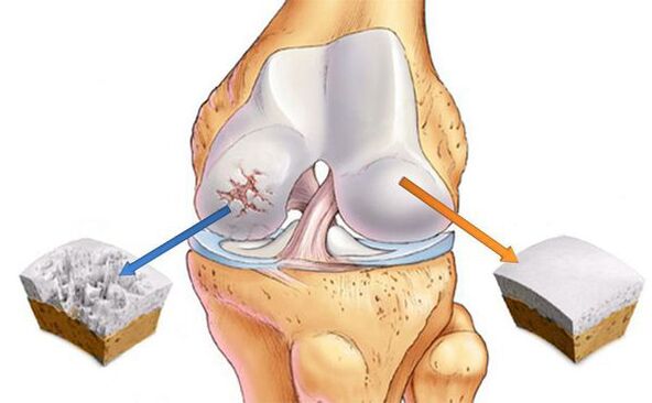 Joint changes in osteoarthritis (left) and normal cartilage (right)