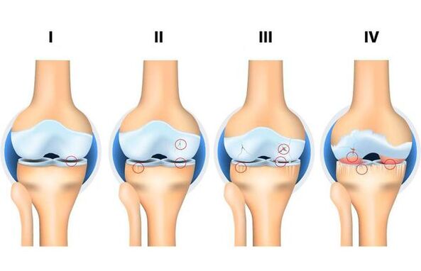 Stages of development of osteoarthritis. 
