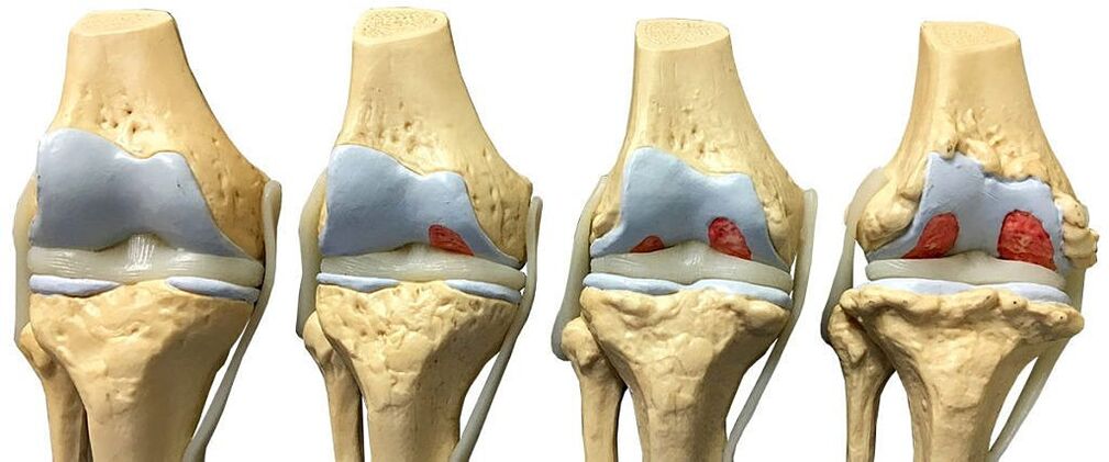 Degrees of osteoarthritis of the knee joint. 