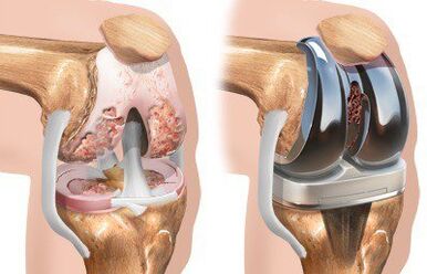 Endoprosthesis of the knee joint with gonarthrosis. 
